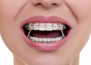 ارتودنسی دندان و انواع مختلف
