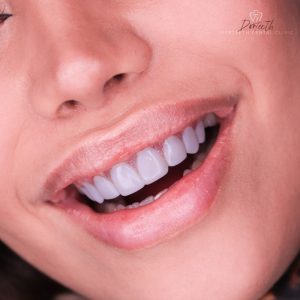 انواع لمینیت دندان
