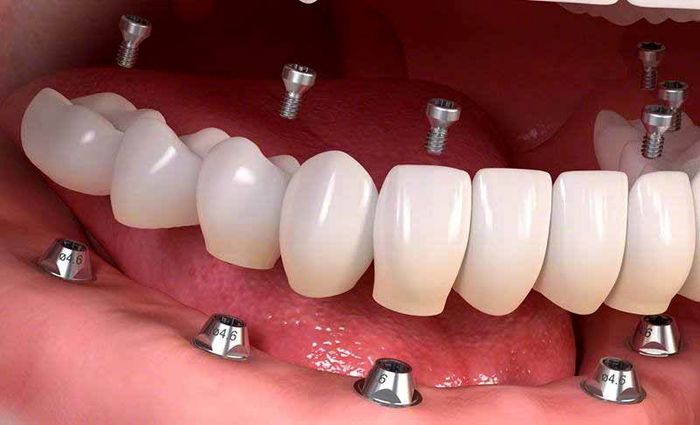 ایمپلنت دندان تهران