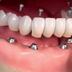 هزینه ایمپلنت دندان در تهران